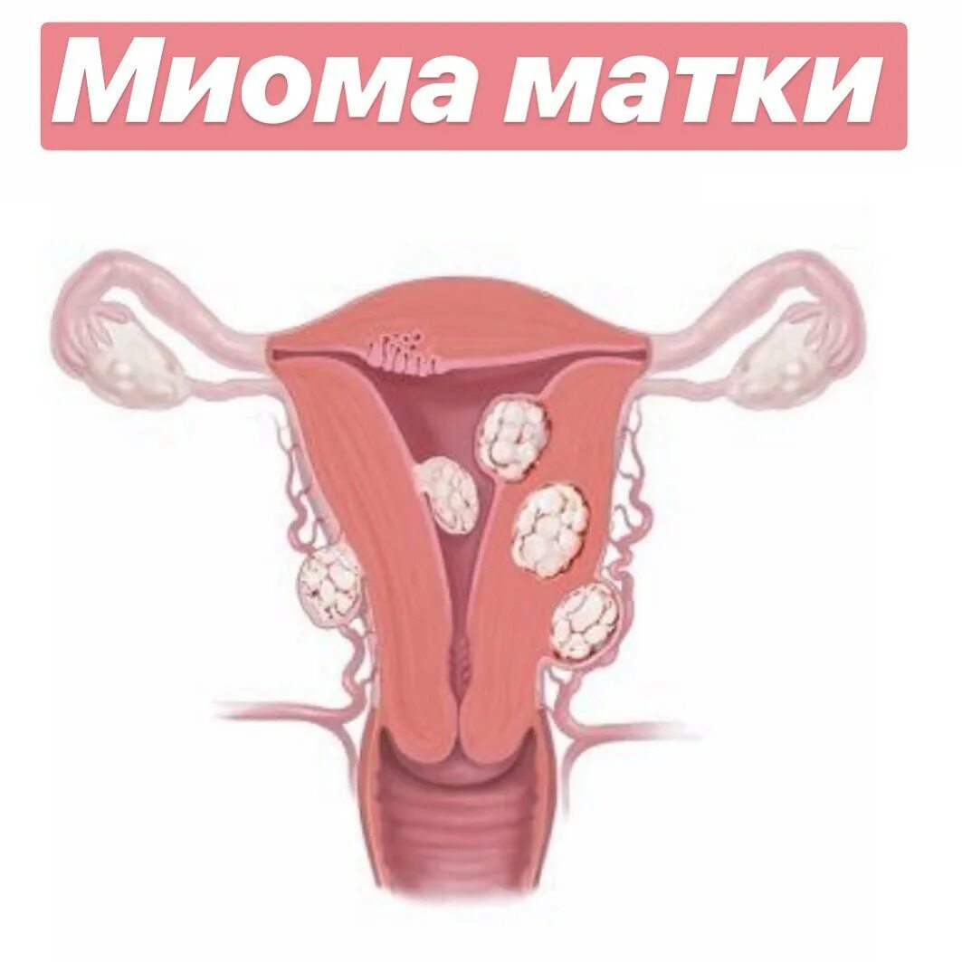фиброма миома матки. фиброма матки операция. интрамуральная лейомиома. интрамуральная миома матки что это такое. интрамурально- субсерозная фибромиома матки.
