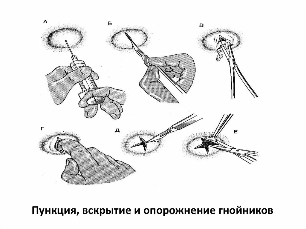 Абсцесс и флегмона крылонебной ямки. После вскрытия абсцесса наложить повязку с. Этапы развития фурункула. После вскрытия абсцесса накладывают повязку с. Флегмона промежности вскрытие.