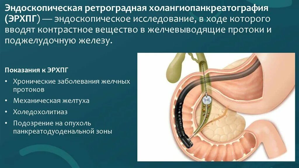 Ретроградная холангиопанкреатография (рхпг). Эндоскопическая ретроградная холангиопанкреатография. Эндоскопическое удаление камней в желчном пузыре. Эндоскопическое удаление камней в желчном пузыре. Литоэкстракция корзинкой дормиа.