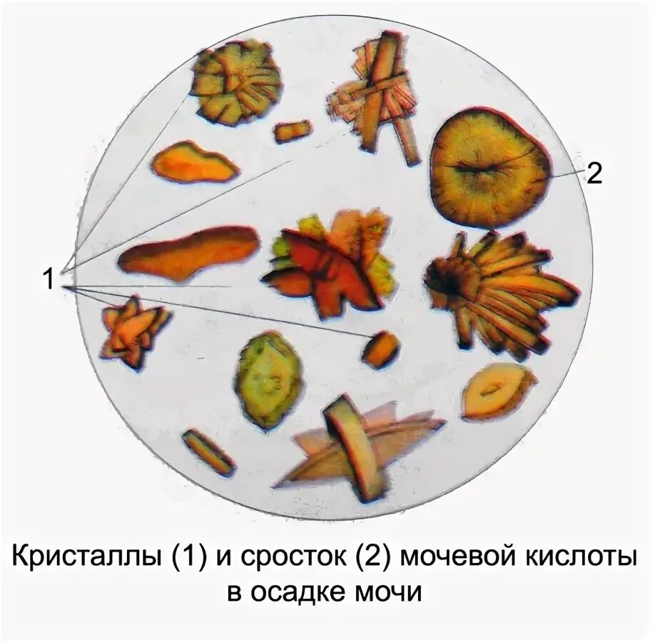 кристаллы мочевой кислоты микроскопия. оли в моче микроскопия. соли мочевой кислоты микроскопия. кристаллы мочекислого аммония в моче под микроскопом. мочевых кристаллов.