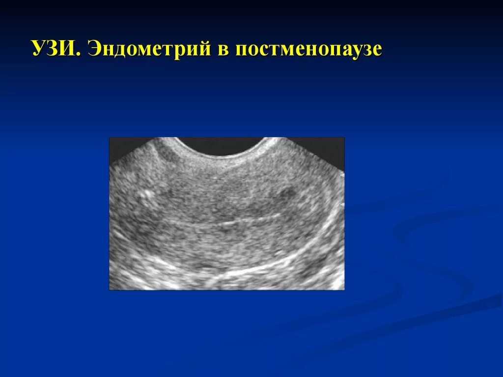 Почему в постменопаузе. Эндометрия матки УЗИ гиперплазия эндометрия. Гиперплазия эндометрия в менопаузе УЗИ. Гиперплазия эндометрия в постменопаузе по УЗИ.