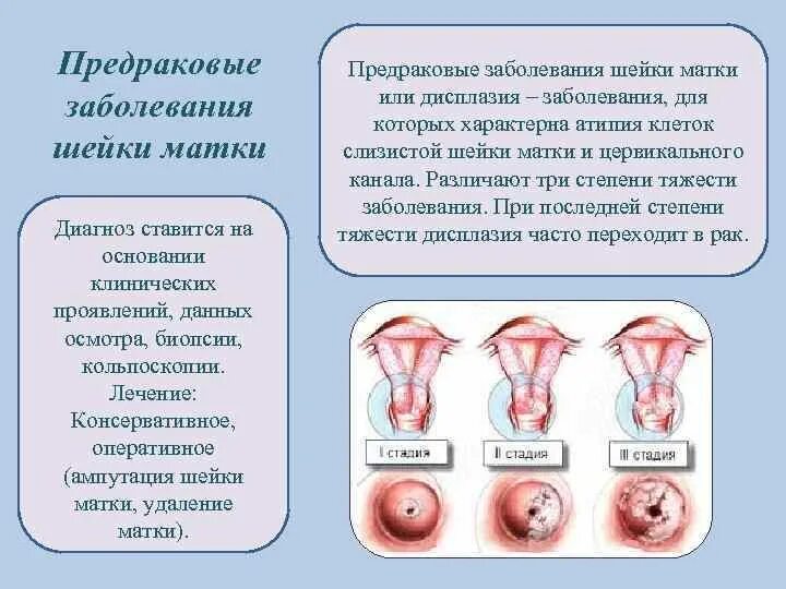 Фоновые и предраковые заболевания матки. Дисплазия 1 степени предрак?. Дисплазия шейки матки клинические. Фоновые и предраковые заболевания шейки матки. Дисплазия шейки матки - это предраковое заболевание!.