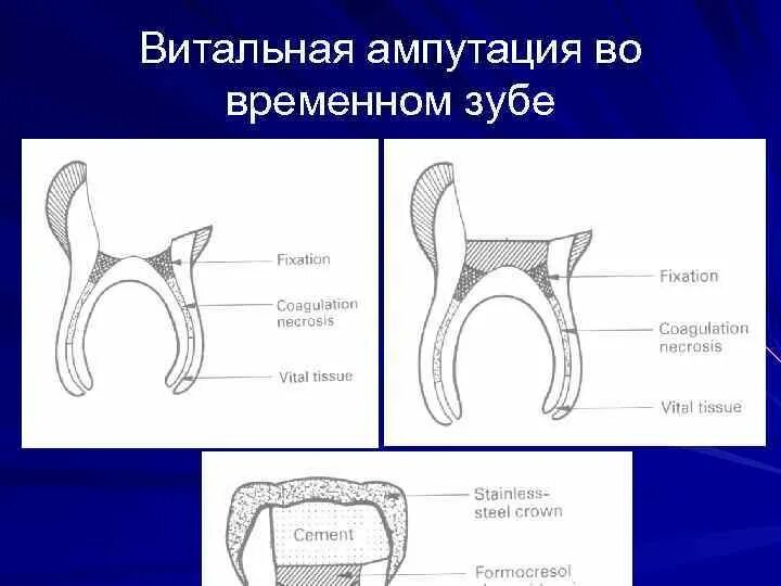 Метод ампутации пульпы. Витальная ампутация пульпы методика. 2. Этапы витальной ампутации пульпы (схема).. Метод витальной ампутации молочных зубов. Девитальная ампутация временных зубов.