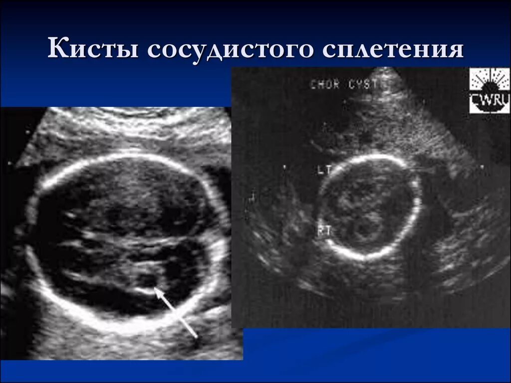 Сосудистая киста головного мозга у плода. Киста сосудистого сплетения. Киста сосудистого сплетения УЗИ. Киста сосудистого сплетения у плода. УЗИ киста сосудистого сплетения у новорожденного.