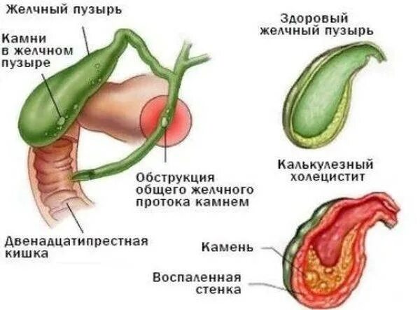 Увеличенный желчный пузырь причины