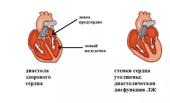 Нарушение диастолической функции левого желудочка по 1. Дисфункция миокарда левого желудочка. Систолическая дисфункция левого желудочка. Диастолическая функция миокарда левого желудочка. Диастолическая дисфункция левого желудочка типы на УЗИ.