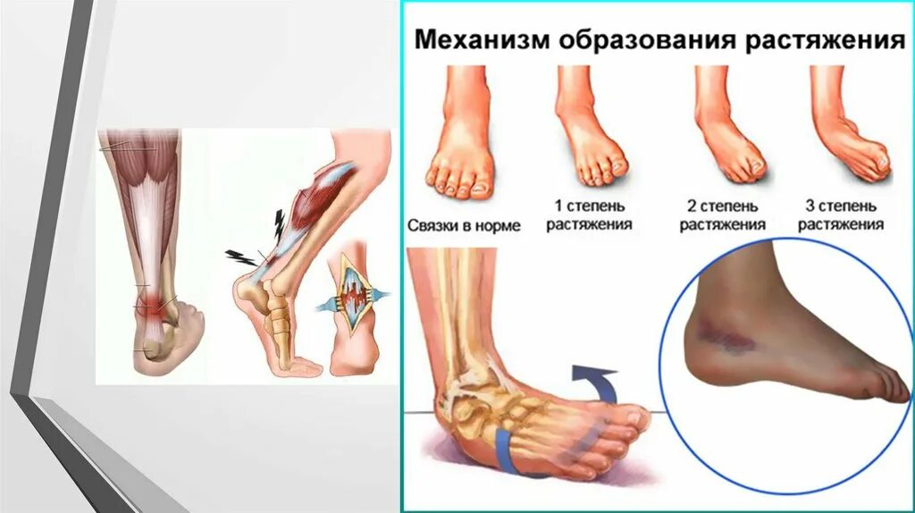 Повреждение капсульного аппарата голеностопного сустава. Степени растяжения голеностопа. Растяжение связок стопы плюсны. Первая помощь при растяжении связок голеностопного сустава. Растяжение связок голеностопа степени растяжения.