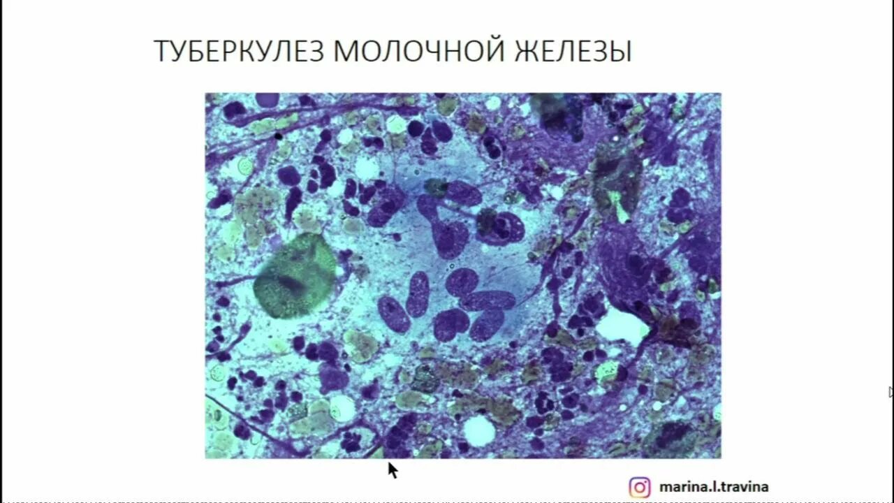 Туберкулез молочной. Туберкулёз молочных желёз. Туберкулёз молочной железы клиника. Туберкулез молочной железы микроскопия.