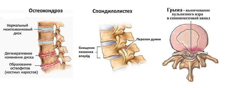 Свечи от боли в пояснице. Свечи от грыжи позвоночника. Свечи от хондроза поясничного. Свечи обезболивания позвоночника. Обезболивающее свечи от боли в пояснице.