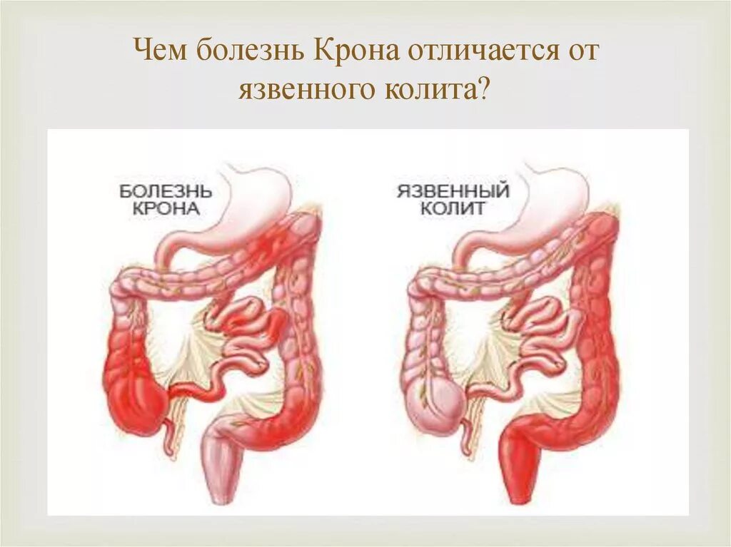 Болезнь крона кишечника симптомы лечение. Заболевания тонкой кишки.