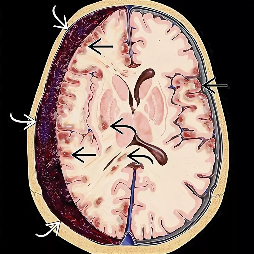 Субдуральная и эпидуральная гематома. Внутричерепная субдуральная гематома. Субдуральная гематома мозга. Субдуральная кровоизлияние головного мозга. Травматическое кровоизлияние