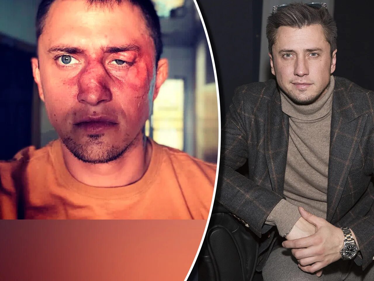 Прилучным после операции. Прилучным после операции. Прилучным после операции. Прилучным после операции. Прилучный после операции на лице.