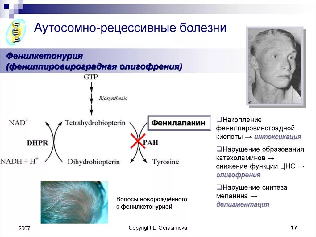 Фенилкетонурия (фенилпировиноградная олигофрения). Фенилкетонурия 2 типа биохимия. Фенилкетонурия и альбинизм. Фенилкетонурия это наследственное заболевание. Рецессивные наследственные болезни