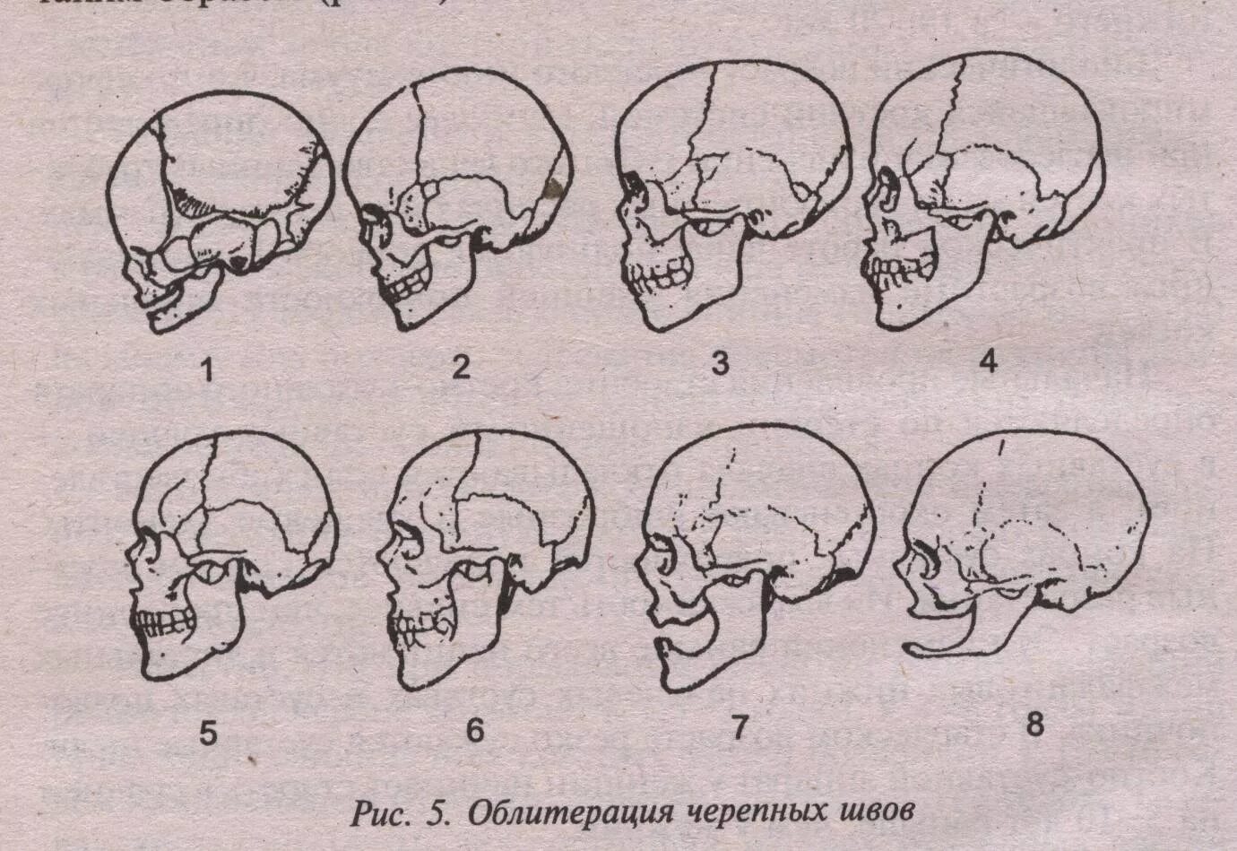 Основным признаком возрастных изменений костей. Зарастание швов черепа схема. Возрастные изменения черепа. Возворастные ищменнеия череп.