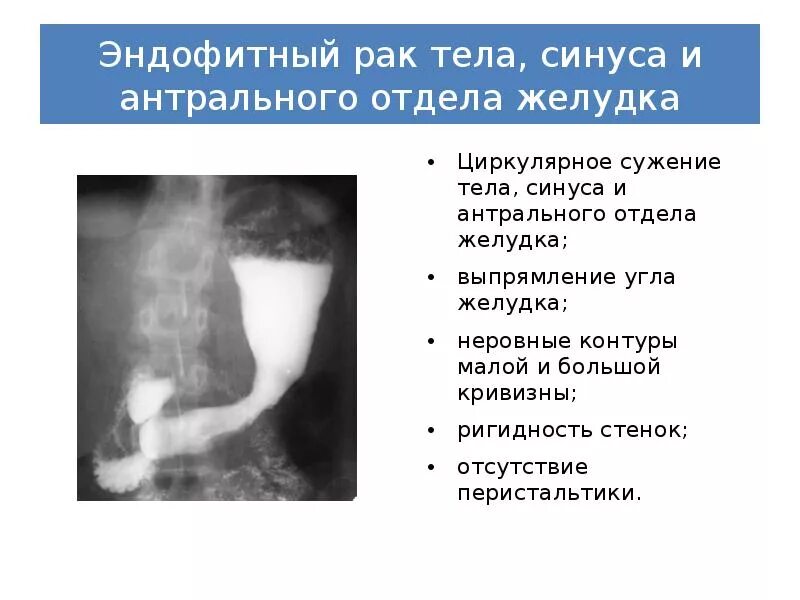 Опухоли жкт осложнения. Тест на рак желудка. Циркулярный дефект наполнения желудка. Онкологические заболевания жкт. Тест на рак желудка.