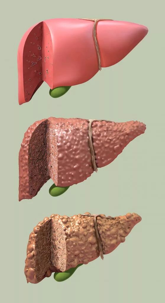 Печень гепатоз жировой гепатоз. Жировой гепатоз 2 степени. Пигментный гепатоз Жильбера. Чем опасна жировая печень