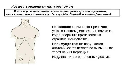 Лапаротомия ревизия гемостаз