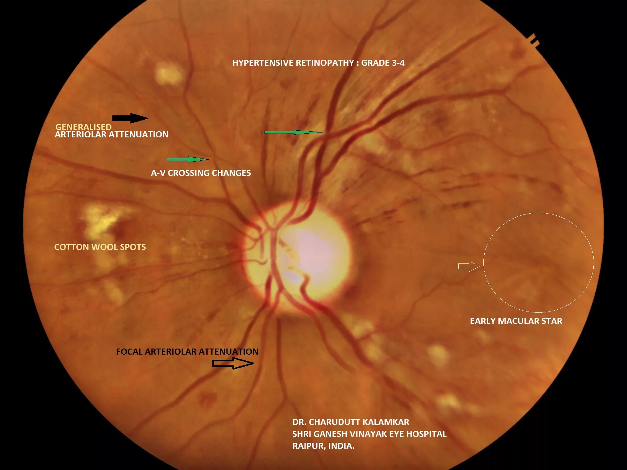 Гипертоническая ангиопатия и ретинопатия. Посттромботическая ретинопатия. Неоваскуляризация диска зрительного нерва. Гипертензивная ретинопатия.
