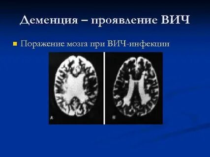 Вич мозга