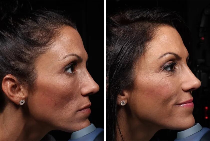 биоармирование гиалуроновой кислотой филлерами. биоармирование лица отзывы. биоармирование овала лица. армирование лица до и после. биоармирование векторный лифтинг.