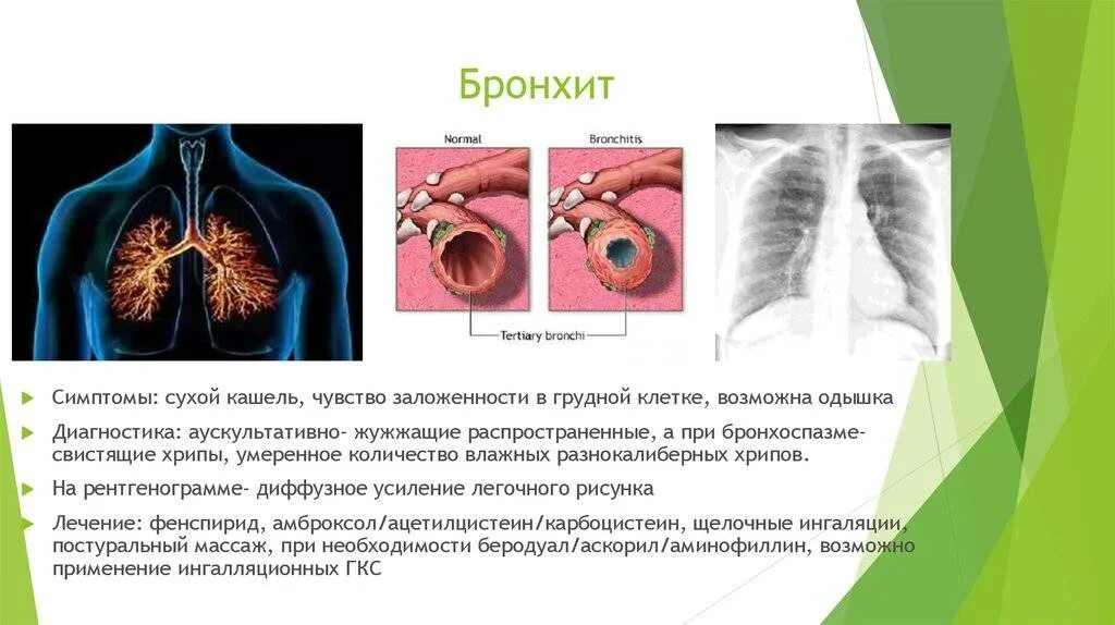 Симптомы при остром бронхите. Основные симптомы бронхита. Симптомы бронхит бронхит. Легкие при сильном кашле