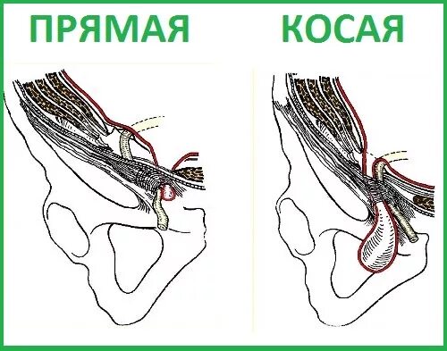 Паховая грыжа косая косая. Схема прямой паховой грыжи. Косая и прямая паховая грыжа. Прямая и косая паховые грыжи