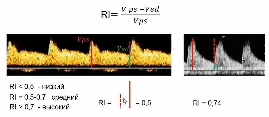 Индекс резистентности в УЗИ измерение. Индекс резистентности формула для сосудов. Индекс резистентности норма. Индекс резистентности и пульсационный индекс. Индекс резистентности артерий