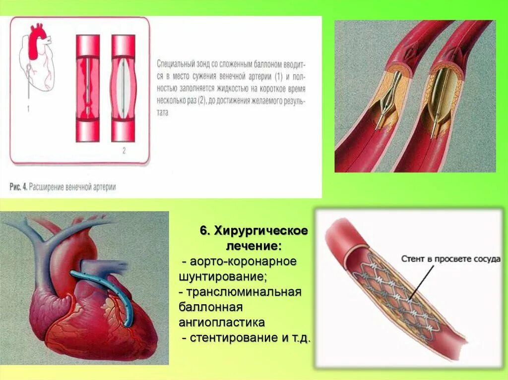 ТРАНСЛЮМИНАЛЬНАЯ баллонная ангиопластика. Шунтирование коронарных артерий. ТРАНСЛЮМИНАЛЬНАЯ ангиопластика коронарных артерий. Баллонная ангиопластика при ИБС. Что такое шунтирование сердца и сосудов