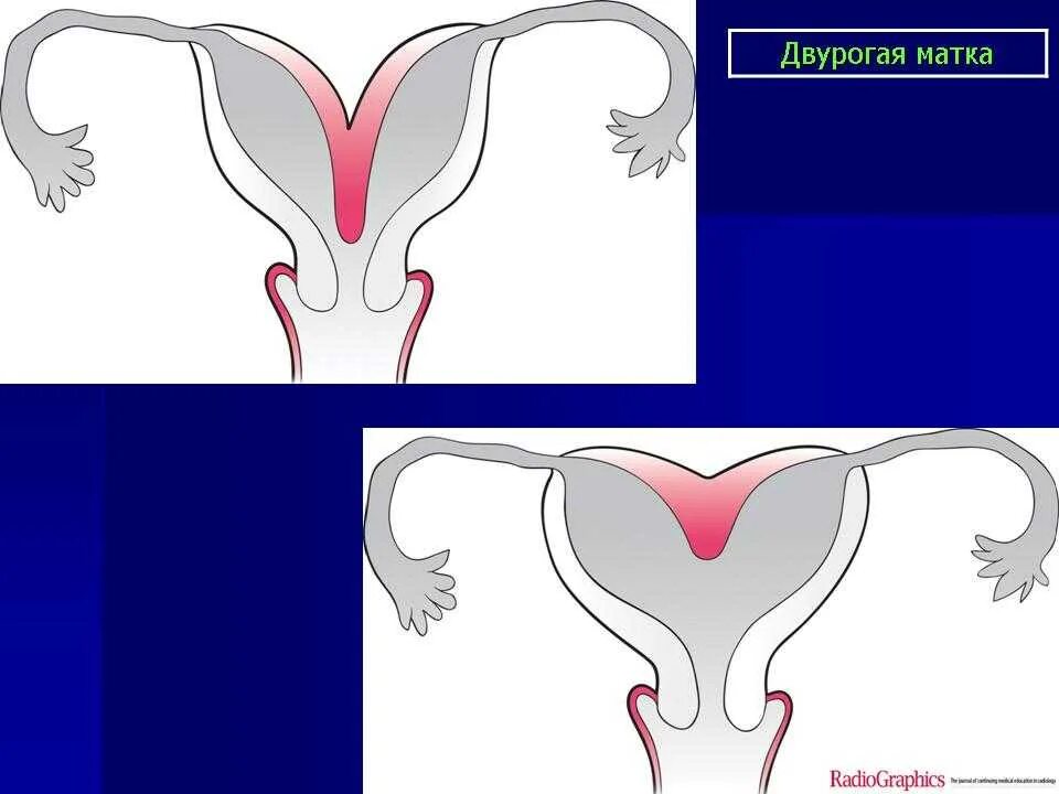 Аномалия матки двурогая. Неполная двурогая матка. Двурогая матка рентген. Что такое двурогая матка