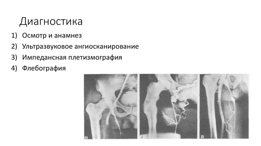 Тромбоз подключичных вен. Флебография подключичной вены. Клиника тромбоза подключичной вены. Тромбоз подключичной вены (синдром Педжета-Шретера).. Тромбоз подключичной вены на УЗИ.