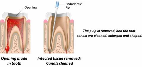 Odabashian Endodontist in Glendale CA offering Root Canal, Toothache, Tooth...
