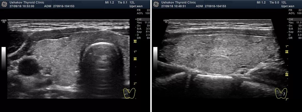 УЗИ "20 МГЦ" щитовидная. Органы шкала серости УЗИ. Перинодулярный кровоток что это