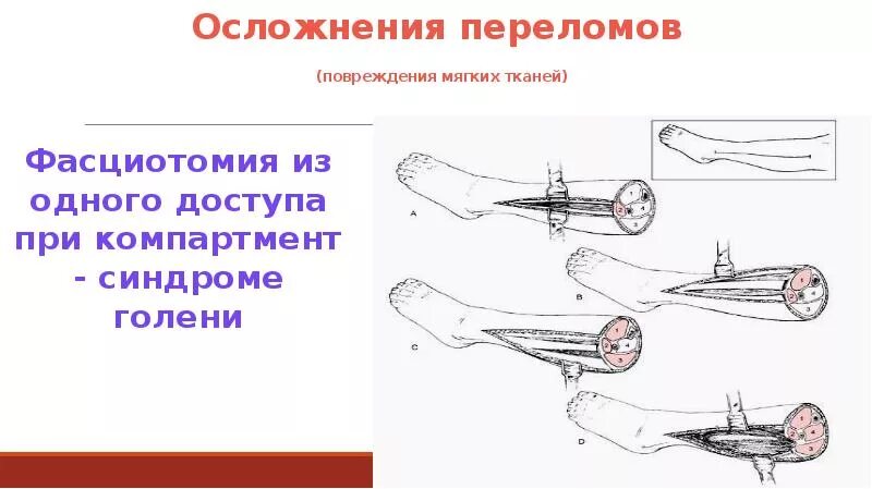 Синдромы в травматологии при переломе. Осложнения переломов повреждение отломками. Осложнения в травматологии. Компартмент синдром при переломе. Возможное осложнение перелома