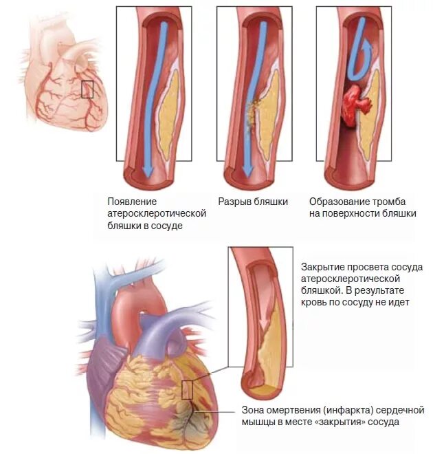 Ишемическая болезнь сосудов. Стентирование коронарных артерий. Разрыв миокарда при инфаркте. Тромб в сердце при инфаркте миокарда. Бляшки инфаркт миокарда.