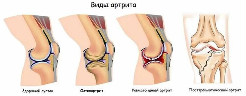 Артрит коленного сустава в домашних условиях. Реактивный артрит коленного сустава. Синовит артроз коленного сустава. Реактивный артрит колена. Артрит суставов коленного сустава симптомы.