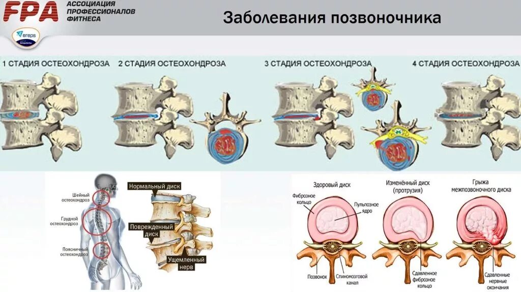 Остеохондроз какие степени