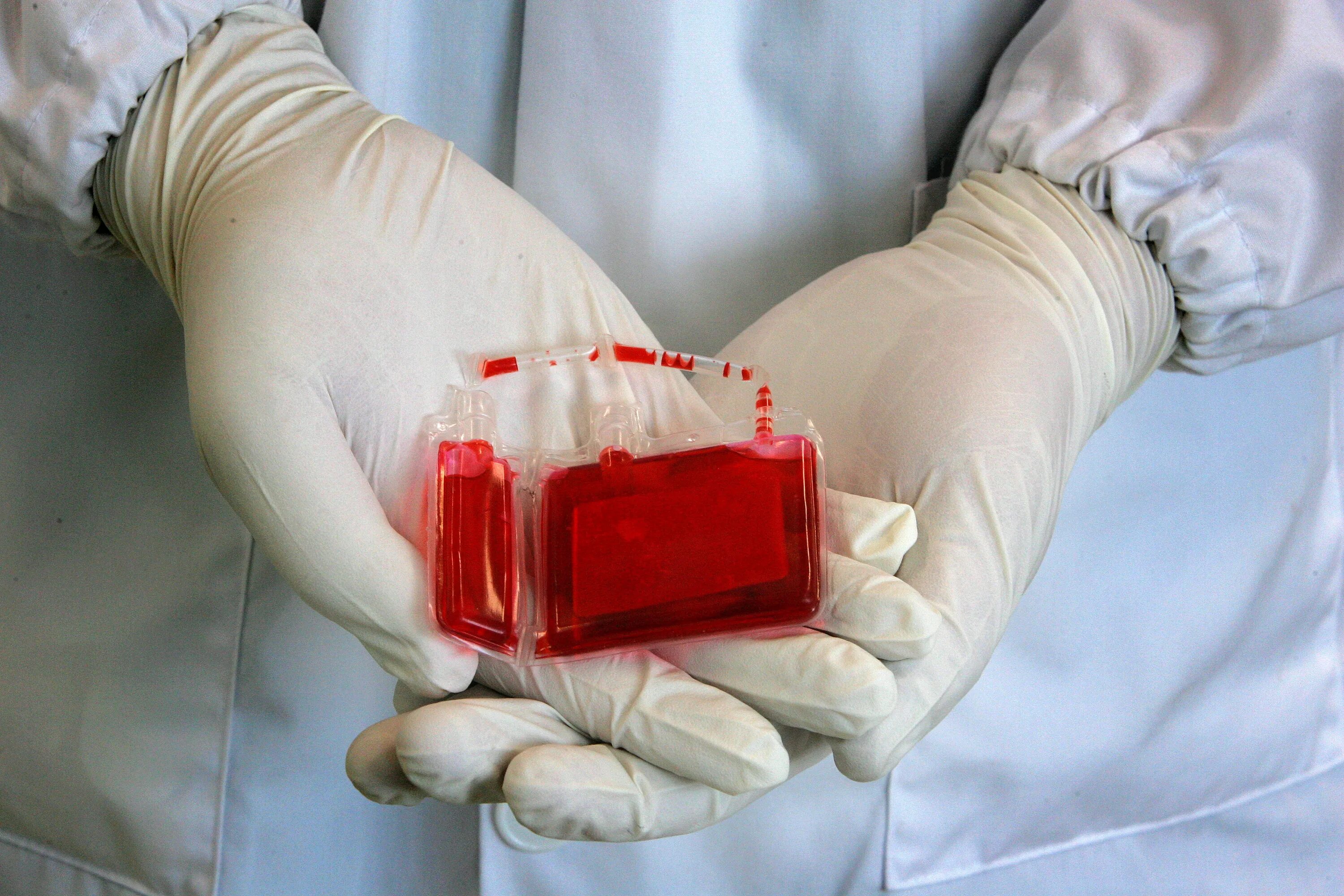 Склеивание крови. Стволовые клетки пуповинной крови. Забор пуповинной крови. Трансплантация пуповинной крови.