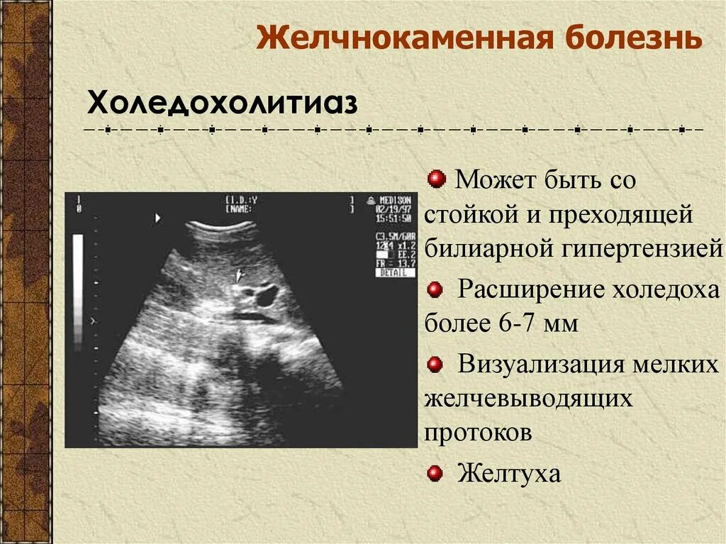 Признаки жкб. Признаки билиарной гипертензии на УЗИ. Признаки желчной гипертензии на УЗИ. Билиарная гипертензия УЗИ признаки.