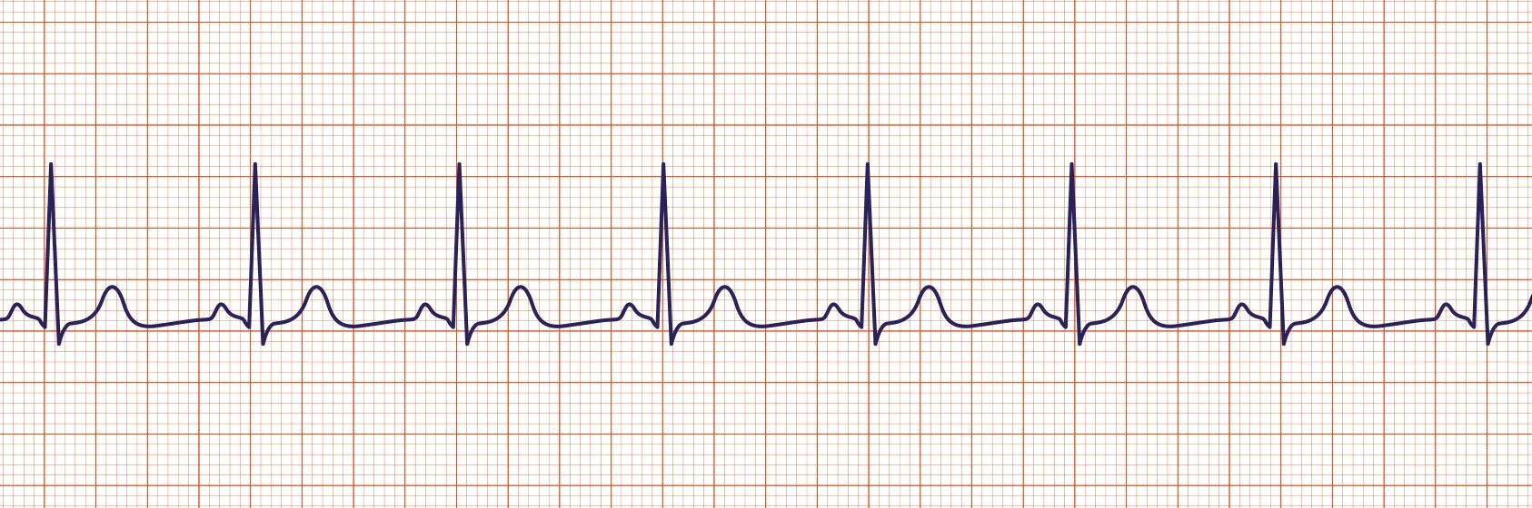 Синусовая тахикардия вертикальное. Брадикардия на ЭКГ. Sinus Rhythm ЭКГ. Нормокардия брадикардия тахикардия. Синус брадикардия.