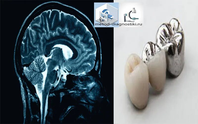 Можно ли с зубным имплантом делать мрт. Мрт головного мозга металлокерамика. Мрт с металлическими коронками.