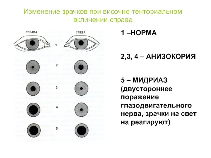 Изменение зрачка. Зрачкибрри сотрясении. расширение зрачка при чмт.