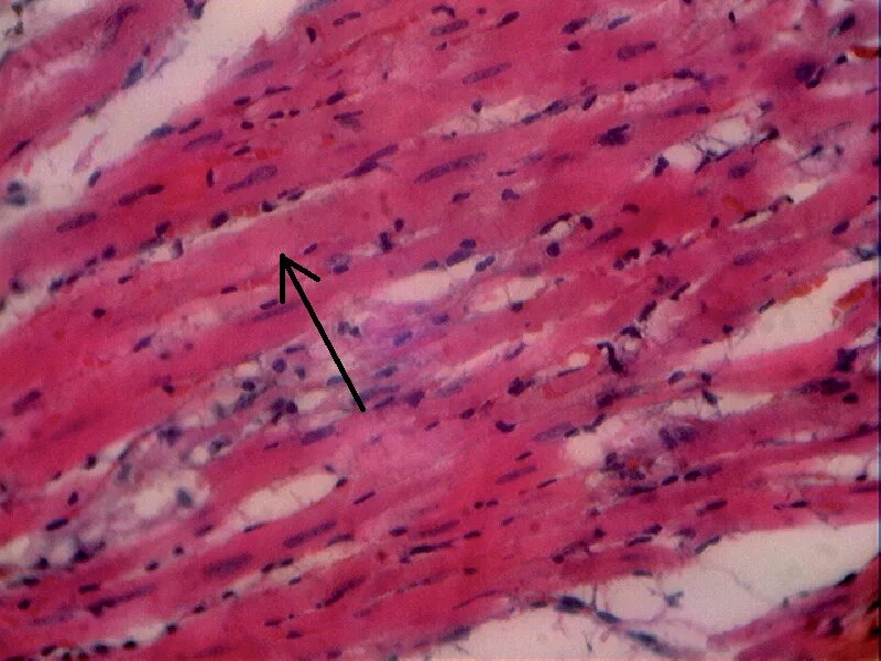 Сердечная ткань миокарда. Инфаркт миокарда гистология. миокард гистология препарат. инфаркт некроз миокарда гистология. миокард под микроскопом гистология.