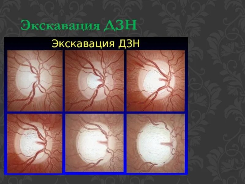 Зрительный нерв при глаукоме. Глаукоматозная экскавация ДЗН. Глаукомная экскавация зрительного нерва. Экскавация глазного дна.