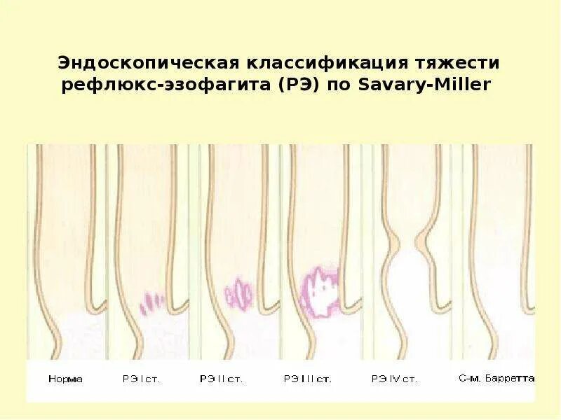 Лос анджелесская классификация эзофагитов. Классификация Савари Миллера ГЭРБ. Рефлюкс-эзофагит классификация. Эзофагит классификация эндоскопическая.