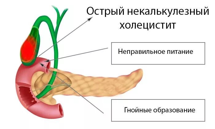 Диета при камнях в желчном пузыре у женщин. Острый холецистит желчекаменная болезнь. Чем опасно голодание. Механизм опорожнения желчного пузыря. Сфинктеры поджелудочной железы.