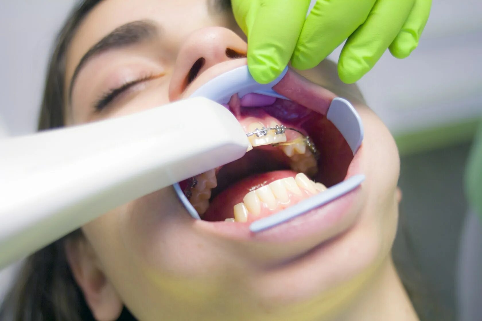 Аск стоматология. Сканирование зубов. Сканирование зубов в стоматологии. Цифровое сканирование зубов.