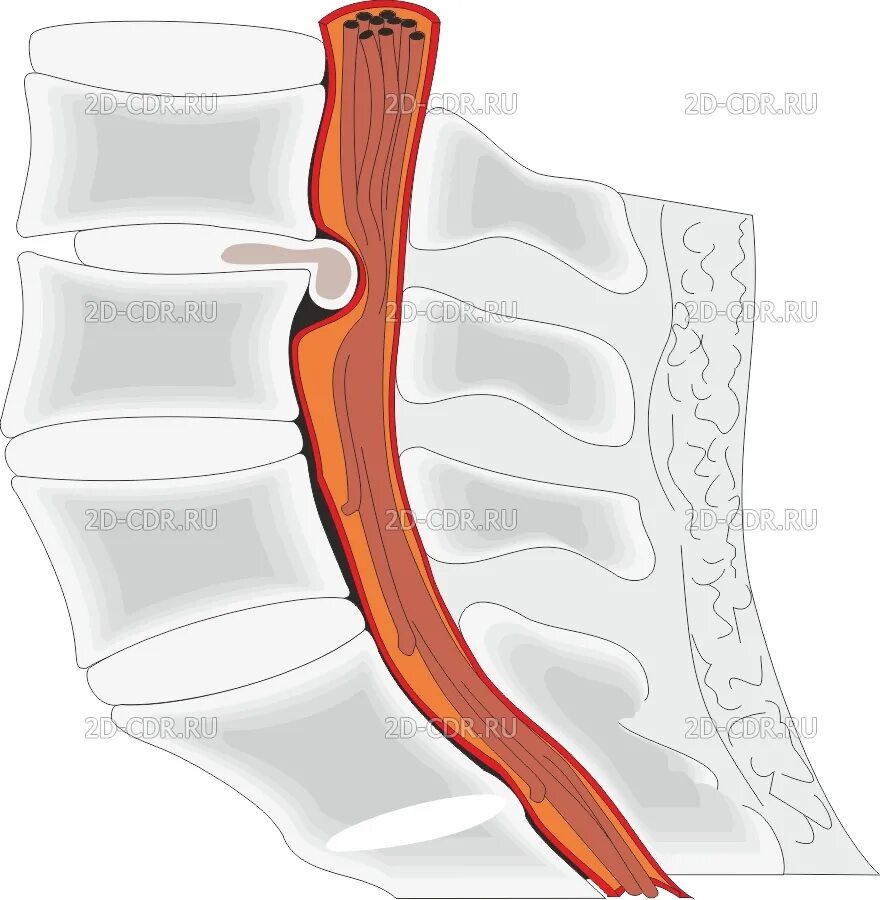 Дорзальная грыжа межпозвонкового диска. Дорзальная протрузия межпозвоночного диска. Дорсальная протрузия дисков. Дорзальная протрузия межпозвонкового диска, грыжа дисков.