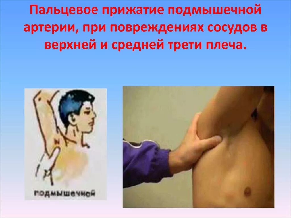 Пальцевое прижатие артерии осуществляется ответ. Пальцевое прижатие артерий. пальцевого прижатия плечевой артерии. пальцевое прижатие сосуда. ранение плечевой артерии.