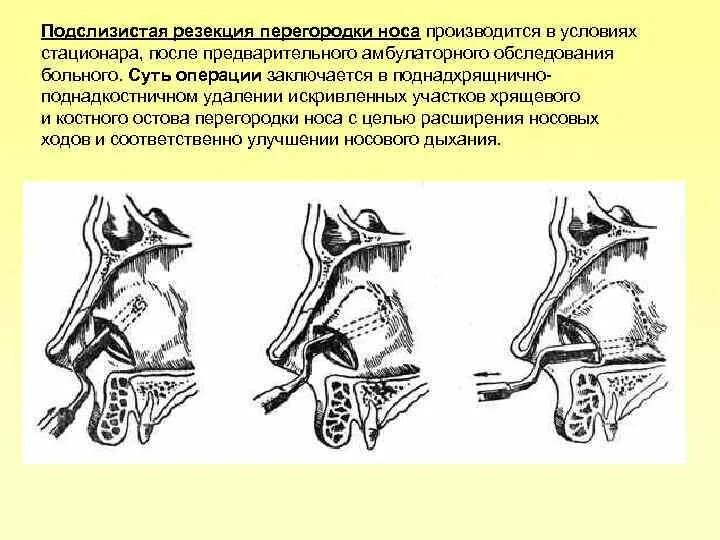 Нижняя подслизистая вазотомия. Резекция носовой перегородки по Киллиану. Септопластика, подслизистая резекция носовой перегородки. Подслизистая резекция носовой перегородки ход операции. Подслизистая резекция перегородки носа по Киллиану.