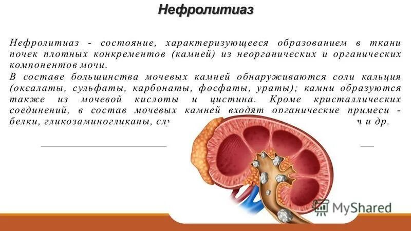 Нефролитиаз почек